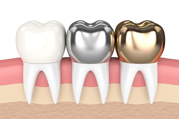CEREC Crowns Vs Traditional &# ; Which Is Better, Bonded Or Cemented In Place?